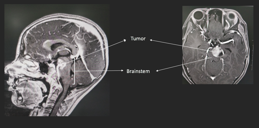 Brainstem Anatomy Mri